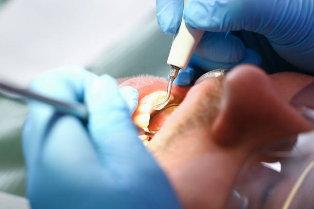 Best Emergency Root Canal Therapy in Milford, NJ